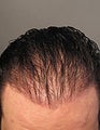 Head FUE and Leg BHT