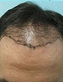 Head FUE and Leg BHT