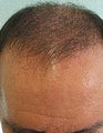 Head and Body FUE SFET Repair