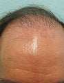 Head and Body FUE SFET Repair