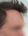 Head and Beard Hair FUE-BHT-SFET to fix follicular unit strip surgery