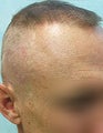 Head and Beard Hair FUE-BHT-SFET to fix follicular unit strip surgery