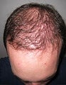 FUE-SFET using head and nape hair only to repair plug transplant