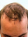 FUE-SFET using head and nape hair only to repair plug transplant
