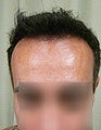 FUE – SFET Using Head and Nape Hair transplant to hairline and frontal scalp