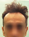 FUE – SFET Using Head and Nape Hair transplant to hairline and frontal scalp