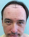 FUE – SFET Using Head and Nape Hair Only