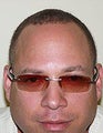 FUE – SFET Using Only Nape and Head Hair for African American Patient