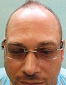 FUE – SFET Using Only Nape and Head Hair for African American Patient