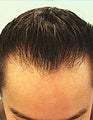 FUE – SFET Using Only Head Hair