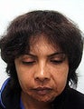 FUE – SFET Using Only Head Hair for Treatment of Lupus