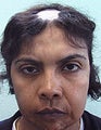 FUE – SFET Using Only Head Hair for Treatment of Lupus
