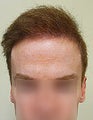 FUE – BHT by SFET Using Body and Head Hair to fix past Scalp Surgery