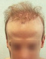 FUE – BHT by SFET Using Body and Head Hair to fix past Scalp Surgery