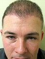 FUE – BHT SFET Using Head and Body Hair to add density