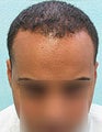 Head and Body Hair FUE- SFET for African American Patient