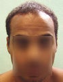 Head and Body Hair FUE- SFET for African American Patient