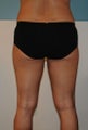 Liposuction Back and Thighs