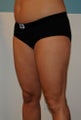 Liposuction Back and Thighs