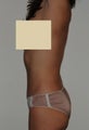 Liposuction