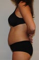 Liposuction