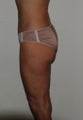 Liposuction