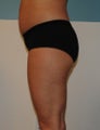 Liposuction