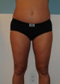 LIposuction