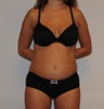 Liposuction
