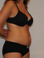 Liposuction