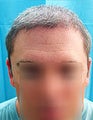 Mixed Head and Body Hair FUE – SFET Hair Transplantation from Nape, Beard, and Body Hair