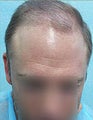 Mixed Head and Body Hair FUE – SFET Hair Transplantation from Nape, Beard, and Body Hair