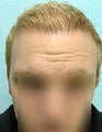 FUE – BHT by SFET Using Head and Body Hair 3,000 graft hairline and scalp