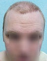 FUE – BHT by SFET Using Head and Body Hair 3,000 graft hairline and scalp