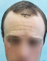 FUE – SFET Using Only Head Hair to Front and Crown Areas