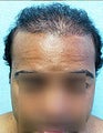 UE – BHT by SFET Using Beard and Chest Hair