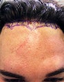 FUE – BHT Using Only Body (Leg) Hair to repair Hair Line