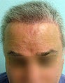 FUE – BHT Using Beard and Body Hair Only 2,000 graft repair using Stomach, Arm, and Leg donor hair