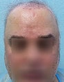 FUE – BHT Using Beard and Body Hair Only 2,000 graft repair using Stomach, Arm, and Leg donor hair