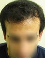 FUE – BHT by SFET Using Nape, Beard and Chest Hair Only