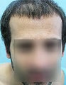 FUE – BHT by SFET Using Nape, Beard and Chest Hair Only