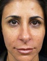 Hydrelle Injection For Treating Laugh Lines or Nasolabial Folds
