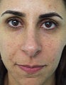 Hydrelle Injection For Treating Laugh Lines or Nasolabial Folds