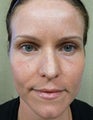 Fraxel Re:pair for Skin Rejuvenation