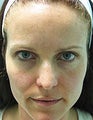 Fraxel Re:pair for Skin Rejuvenation