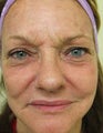 Fraxel Re:pair for Skin Rejuvenation