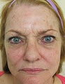 Fraxel Re:pair for Skin Rejuvenation