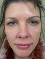 Hydrelle Injection for Treating Laugh Lines or Nasolabial Folds