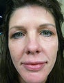 Hydrelle Injection for Treating Laugh Lines or Nasolabial Folds