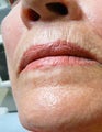 Fraxel Re:pair for Skin Rejuvenation